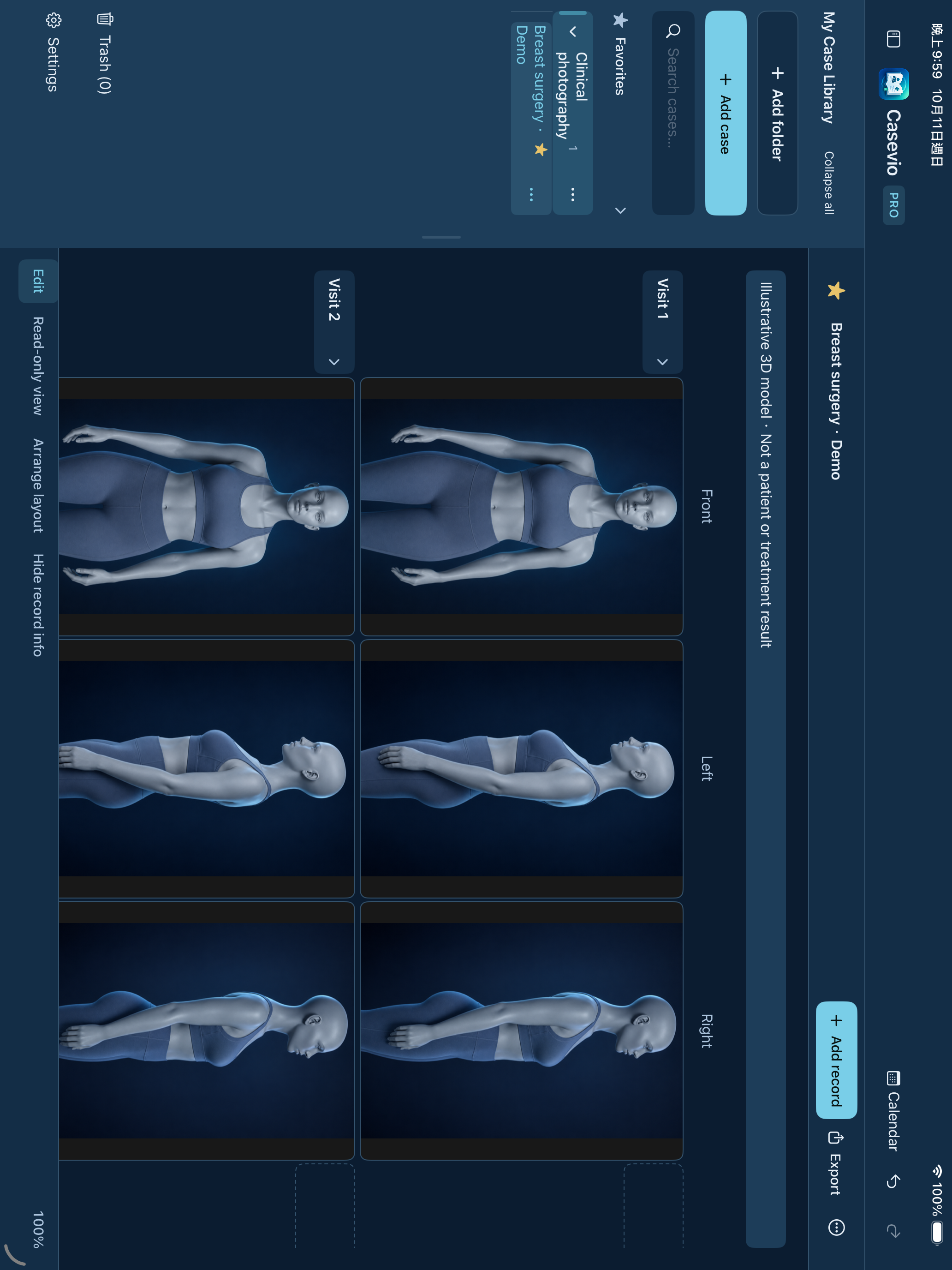 Actual Casevio iPad interface: clothed adult 3D models illustrate front and side views for breast surgery case organisation, with more angle columns extending right.